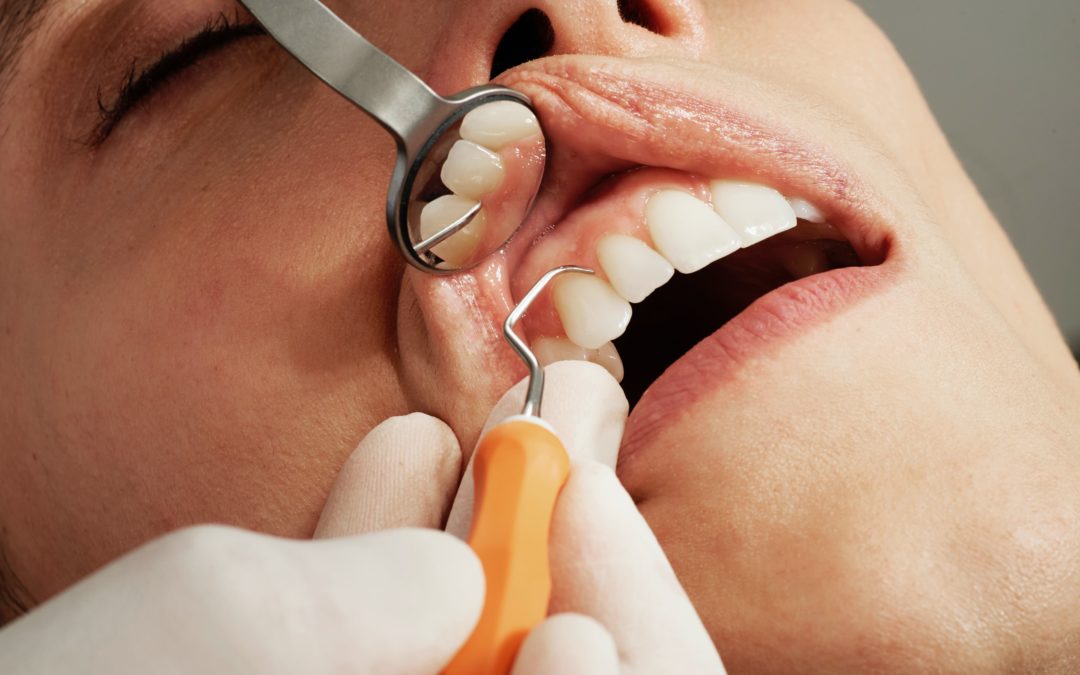What To Do When You Have A Broken Or Chipped Tooth