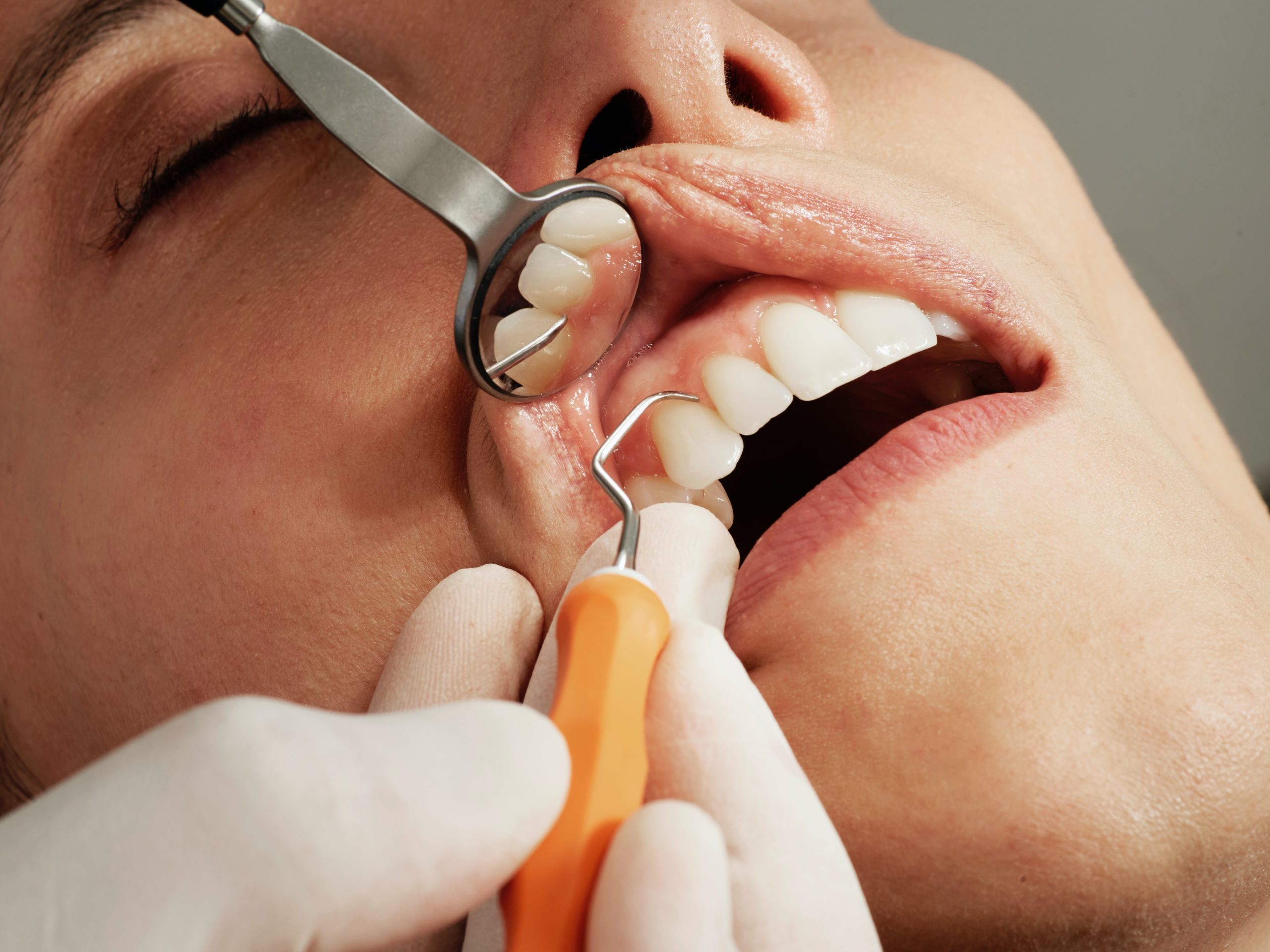 what to do when you have a broken or chipped tooth