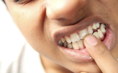 What To Do When You Have A Broken Or Chipped Tooth