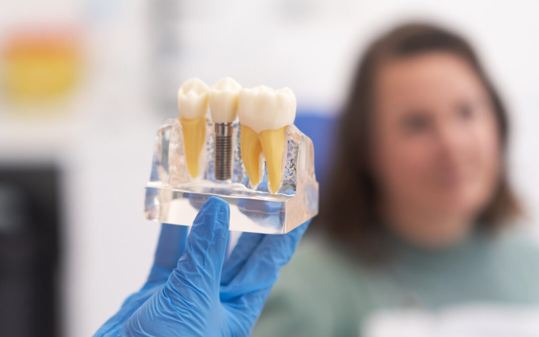 The Difference Between Dental Crowns And Veneers