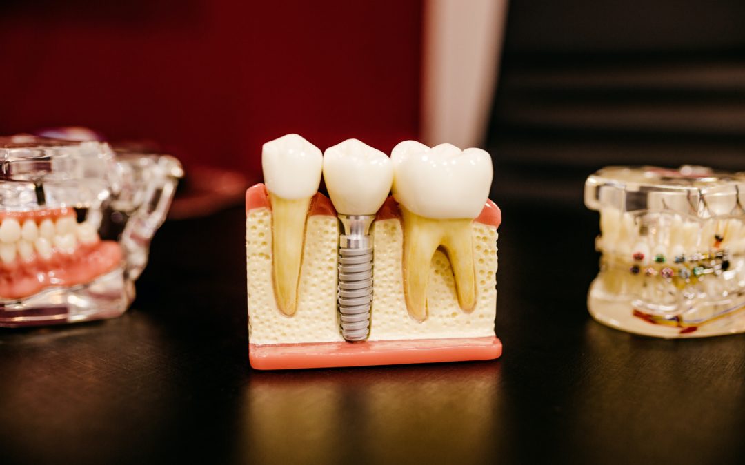 The Difference Between Dental Crowns And Veneers