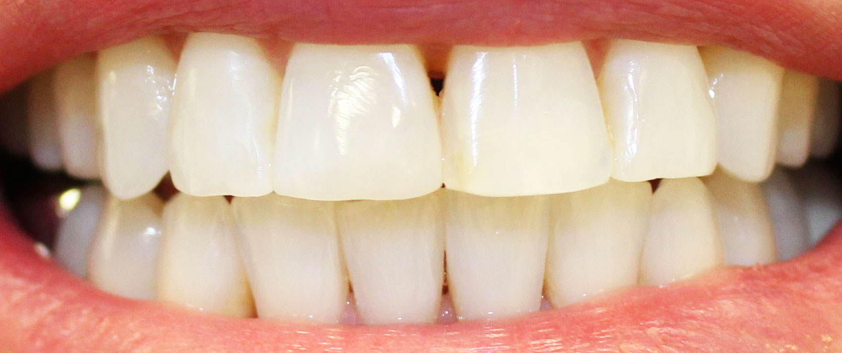 Smile after dental treatment