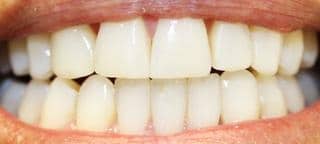 After invisalign, teethwhitening & composite bonding