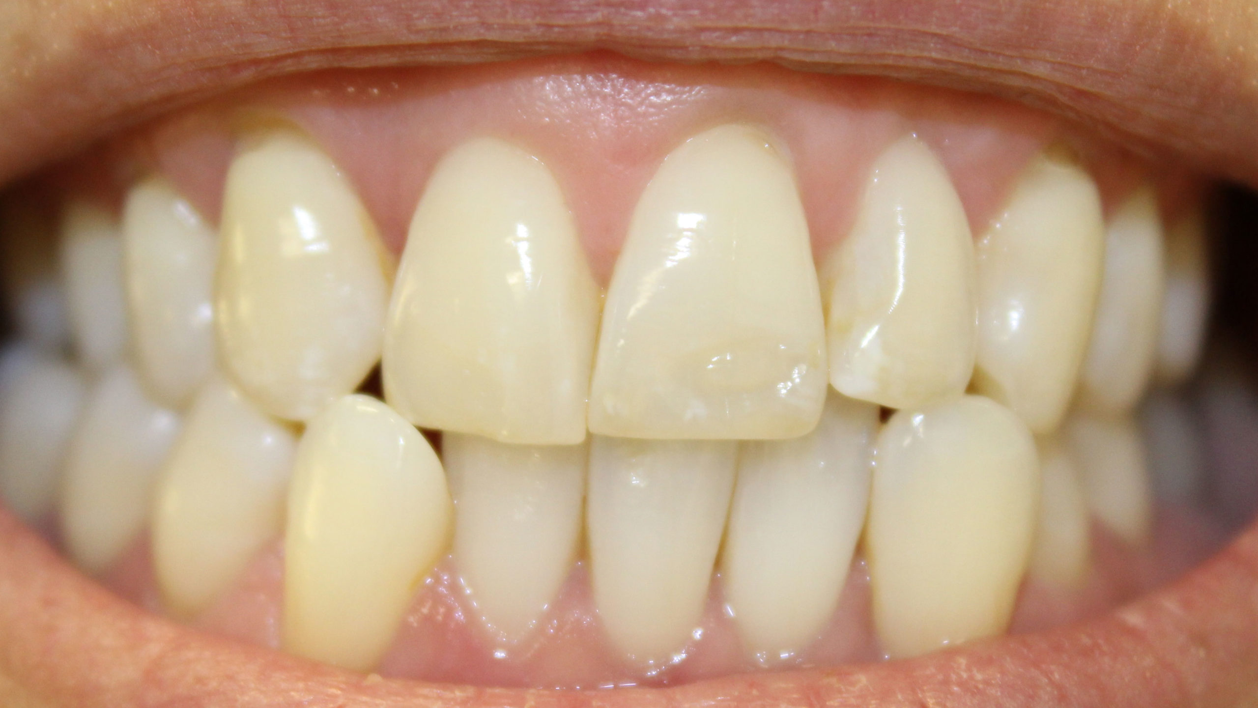 Before invisalign, teethwhitening & composite bonding
