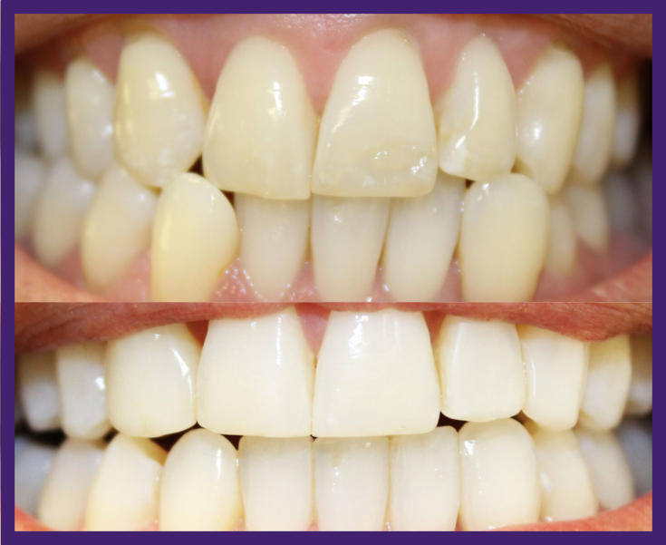 Before and after of a patient who had Invisalign, teeth whitening and composite bonding.