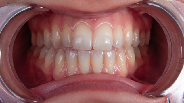 Why Dental Airflow