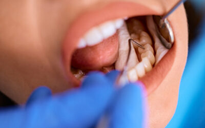 The Difference Between White Fillings & Composite Bonding