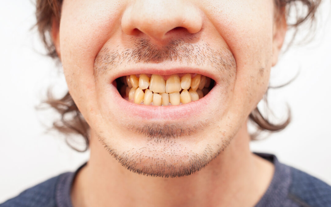 How To Get Rid Of Yellow Teeth