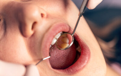 Are White Tooth Fillings Better Than Silver Fillings?
