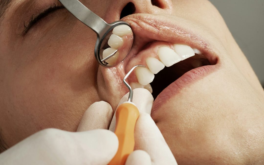 What Do Black Spots On Your Teeth Mean?