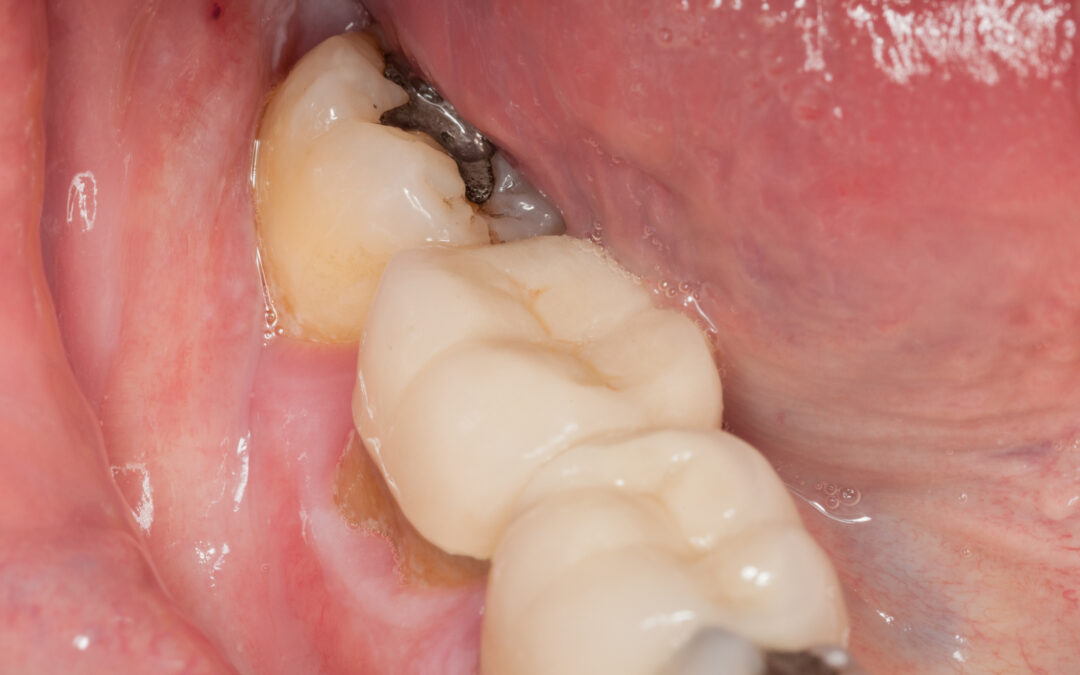What Do Black Spots On Your Teeth Mean?