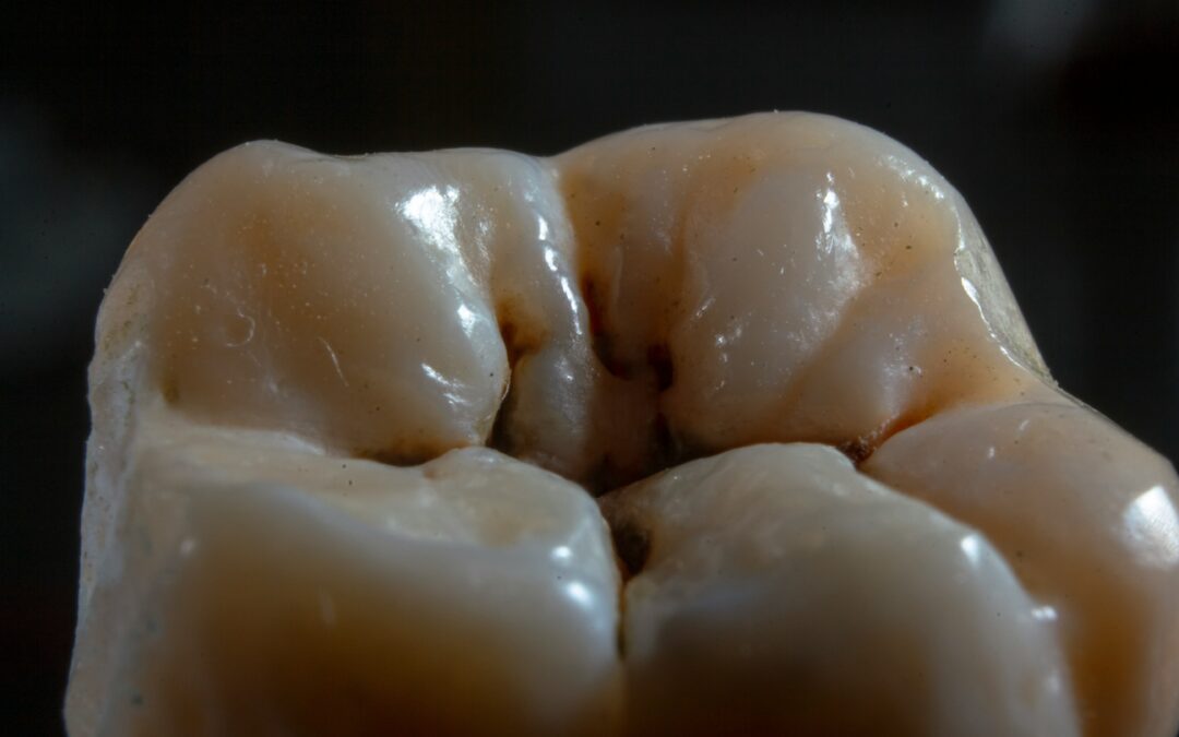 What Do Black Spots On Your Teeth Mean?