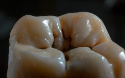 What Do Black Spots On Your Teeth Mean?
