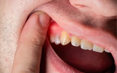 Spitting Up Blood When Brushing Teeth: What Does It Mean?