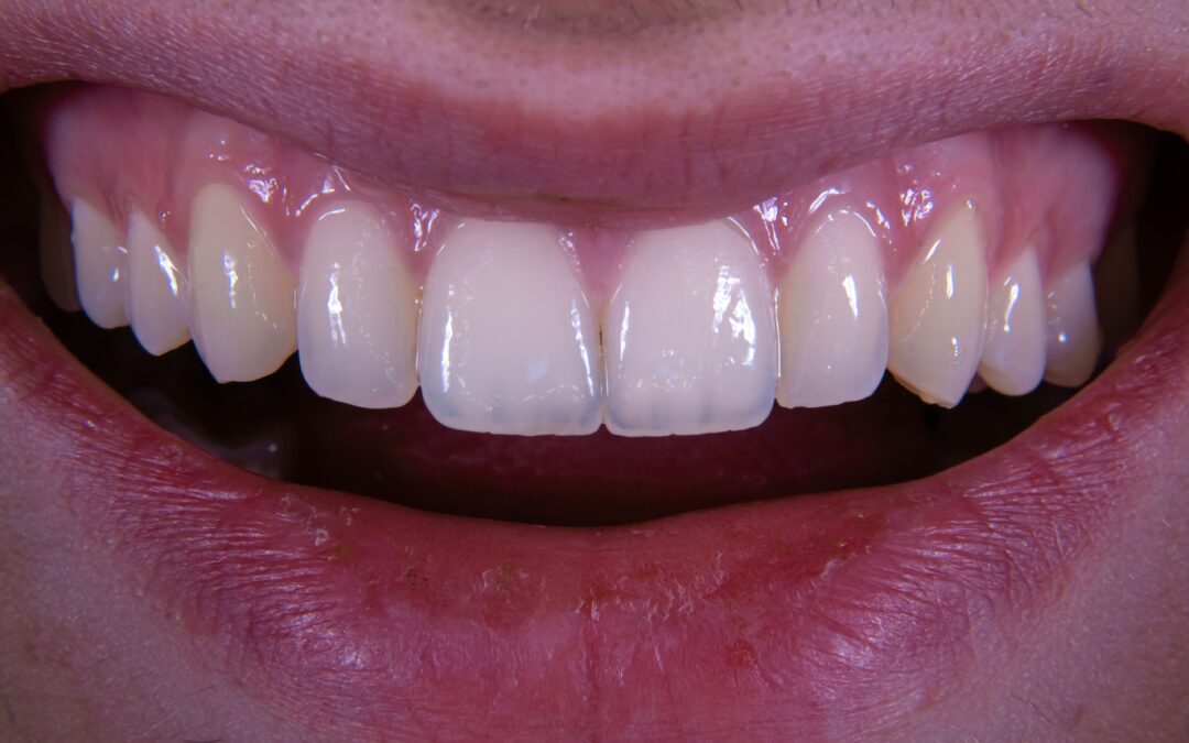 What Do White Spots On Your Teeth Mean?