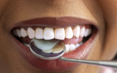 What Do White Spots On Your Teeth Mean?