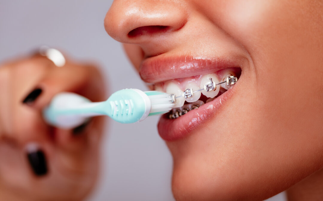 How to Brush Your Teeth While Wearing Braces