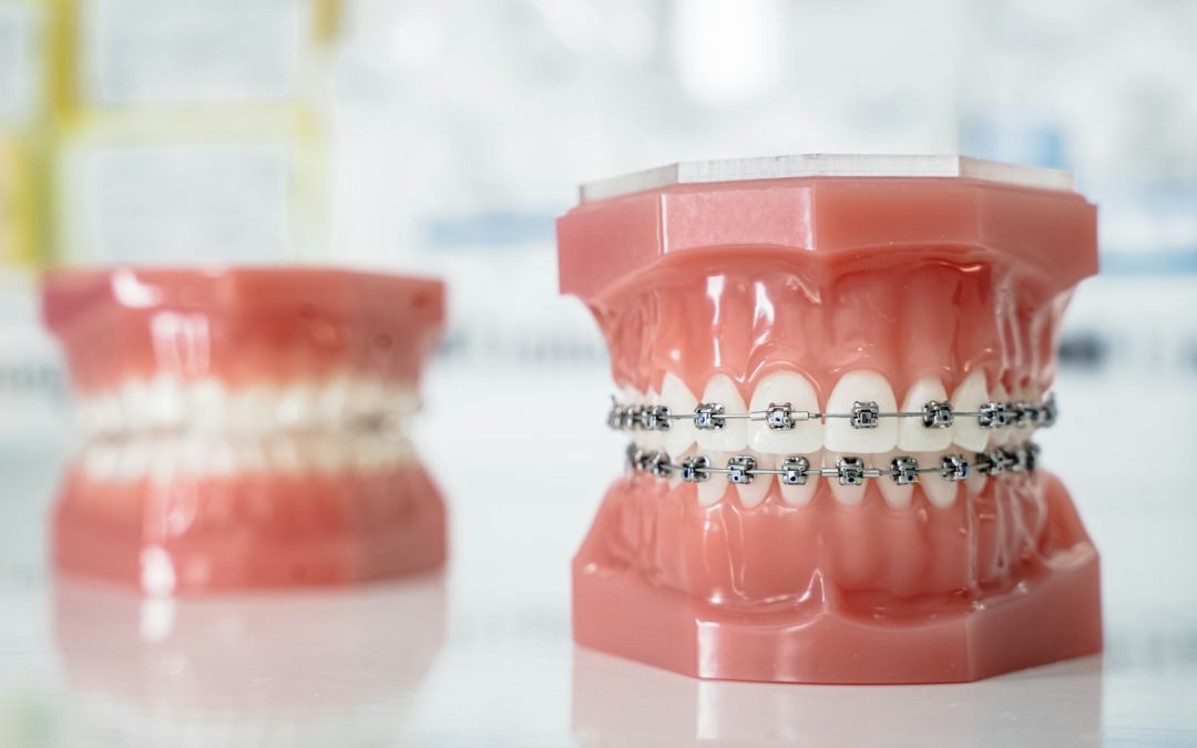 How to Brush Your Teeth While Wearing Braces