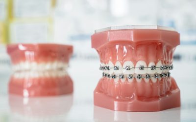 How to Brush Your Teeth While Wearing Braces