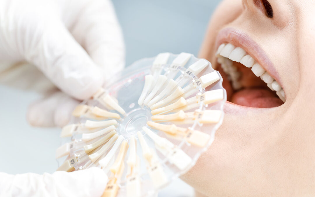 How to Minimise Tooth Sensitivity after Professional Whitening