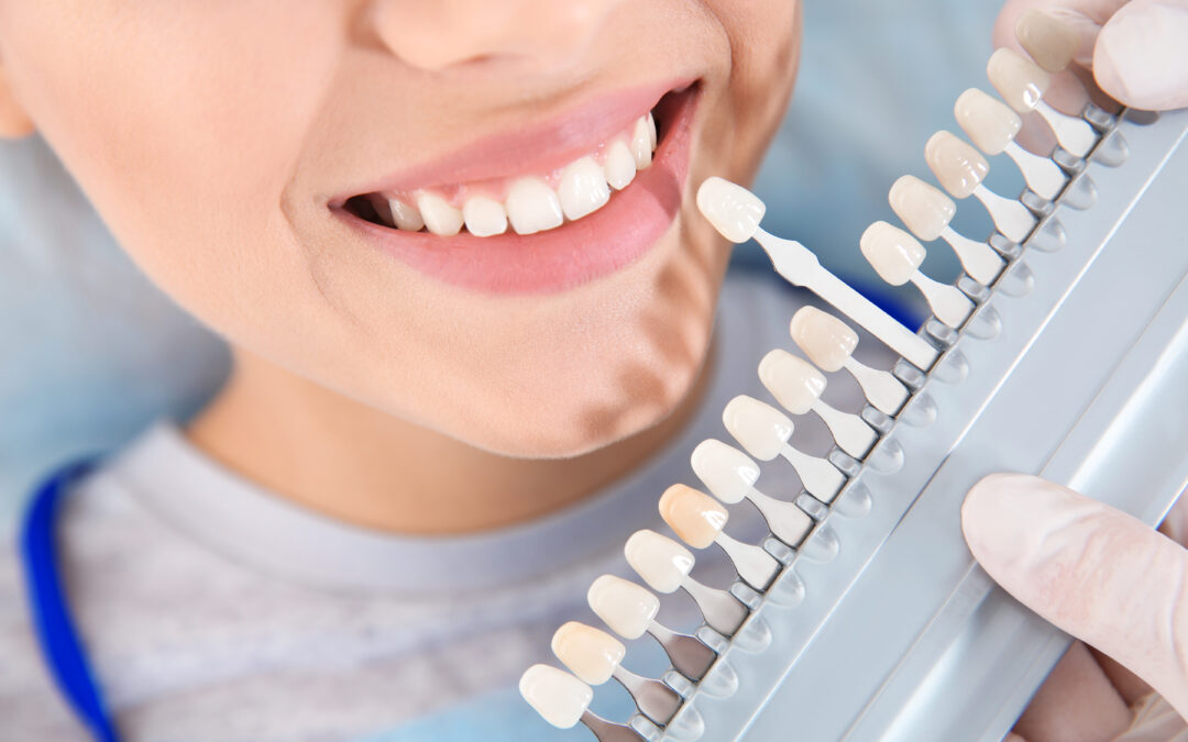 How to Minimise Tooth Sensitivity after Professional Whitening