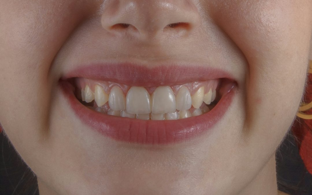 Can a Chipped Tooth Grow Back?