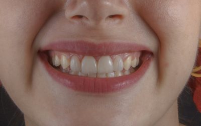 Can a Chipped Tooth Grow Back?